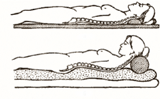 Figur der Osteochondrose