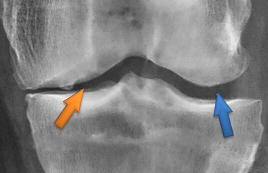 Kineithetorapie für Arthrose
