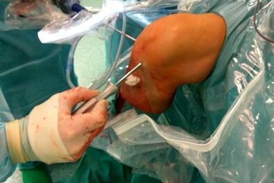 Operation für Arthrose