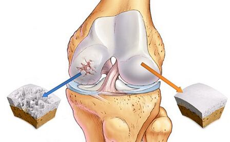 Was ist die Arthrose des Kniegelenks